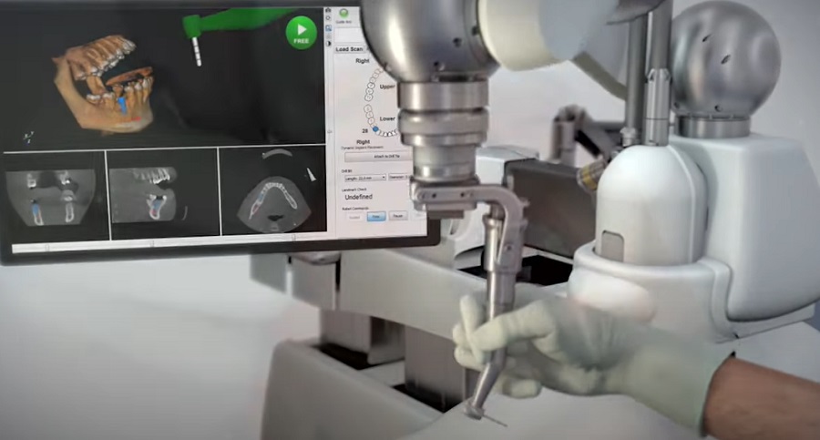Napjainkban a fogászati robot képes fogimplantátum beültetésére